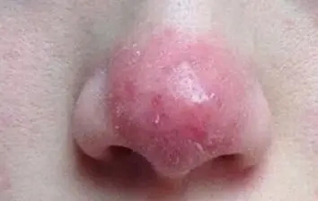 珠海香洲皮肤病医院